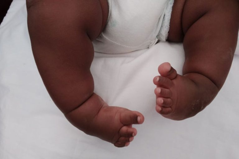 10,000 Children Born With Clubfoot Yearly – NGO