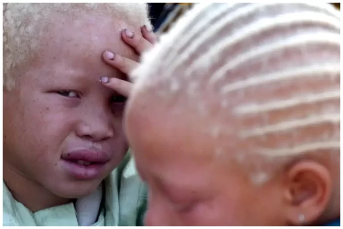 albinism