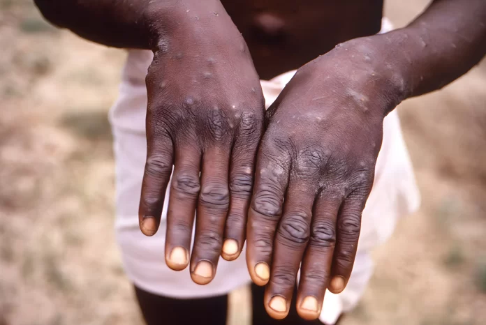 MONKEY POX
